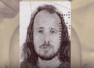 Tragjike / Shqiptari ndërron jetë pas transplantit të flokëve në Turqi