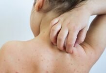 Diagnostohet rasti i parë me fruth në Shqipëri, i infektuar një fëmijë i pavaksinuar që ka ardhur nga Anglia