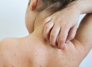 Diagnostohet rasti i parë me fruth në Shqipëri, i infektuar një fëmijë i pavaksinuar që ka ardhur nga Anglia